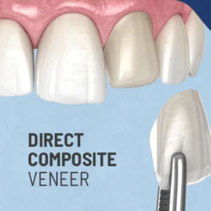 Composite Veneer