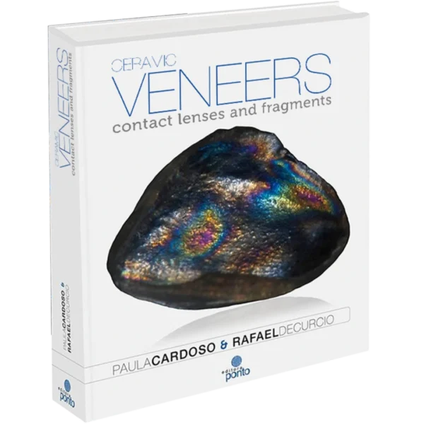 Ceramic veneers contact lenses and fragments Ceramic veneers: contact lenses and fragments